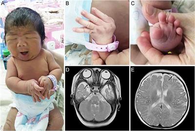 Case Report: A de novo Variant in NALCN Associated With CLIFAHDD Syndrome in a Chinese Infant